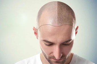 Hair Transplant