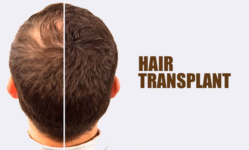 hair transplant in surat